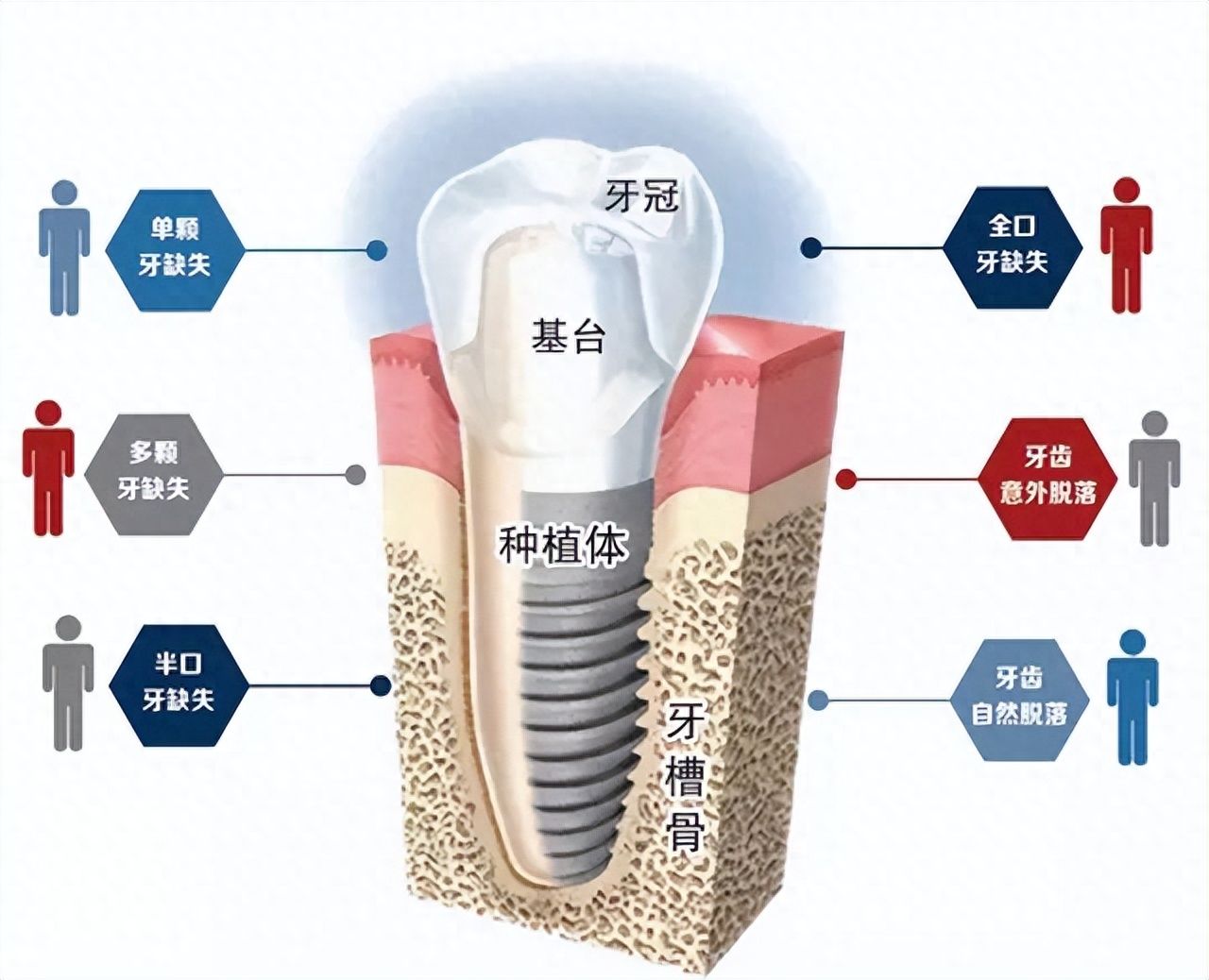 东莞恒好口腔种牙价格查询：韩国登腾3980元起，全口5万起 vs. 实际花费多少？