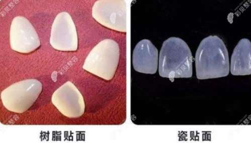 广州口腔门诊如何？瓷贴面分享及价格大揭秘