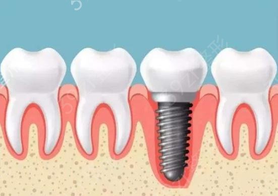 南通市哪家口腔医院牙齿种植整形效果好？