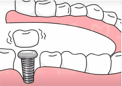揭秘淄博孙孟口腔的真人案例，了解种植牙的价位