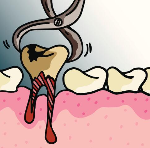 蛀牙痛苦难忍，是否有其他改善方法？试试这些解决方案