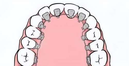宜昌牙齿矫正器价格解析，不同矫正方式对比！