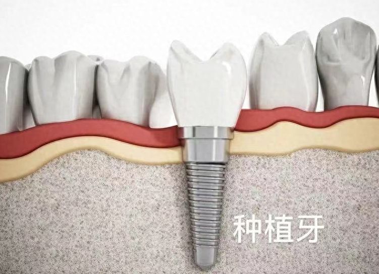 湖北黄冈当地常光顾的牙科医院排行及种牙价格分析