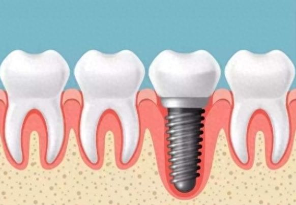 淮安口腔种植牙价格一览：2024年最新价目表揭秘！