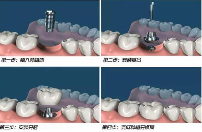 重庆瑞泰口腔2024收费表：种植牙、正畸价格汇总+分院地址