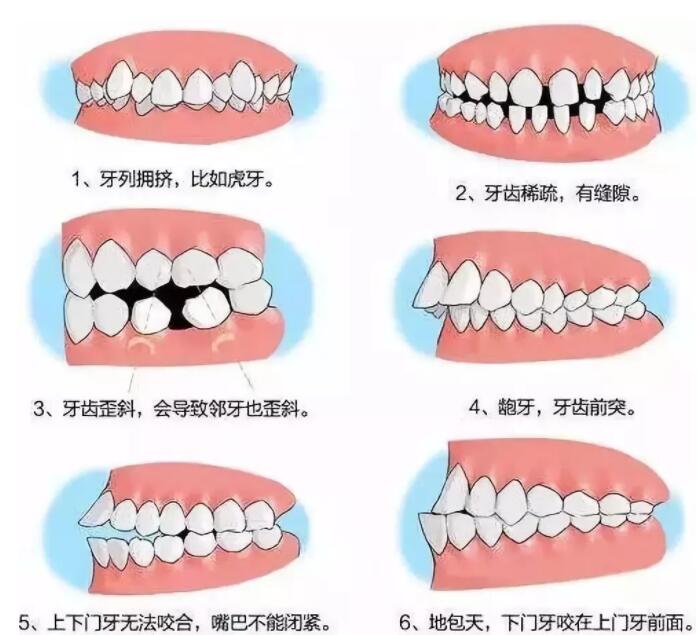 牙科植入基台的材质及颜色差异解析