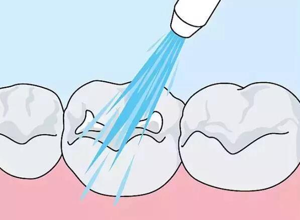 广州广大口腔何锦泉3D导板正颌手术效果及费用指南