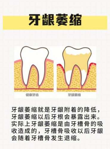 摘除牙套的步骤揭秘，超清流程图解析